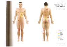종부원리-다리-고관절 무혈성괴사(우)_고관절 탈출증(우)