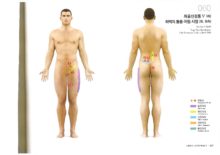 좌골신경통5(좌)_허벅지통증.저림.시림(좌.외측)
